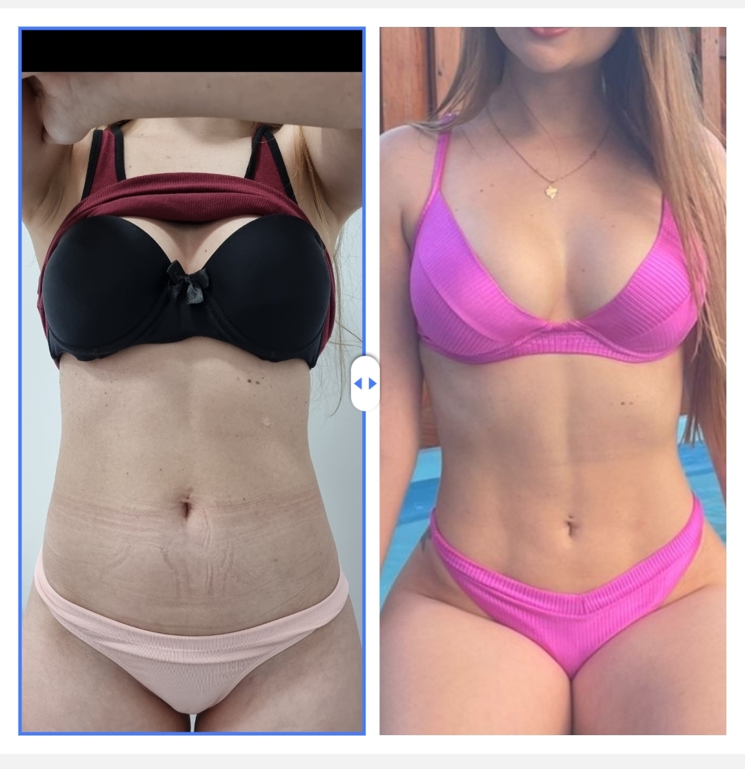 Antes e Depois Minilipolaser - Abdômen
