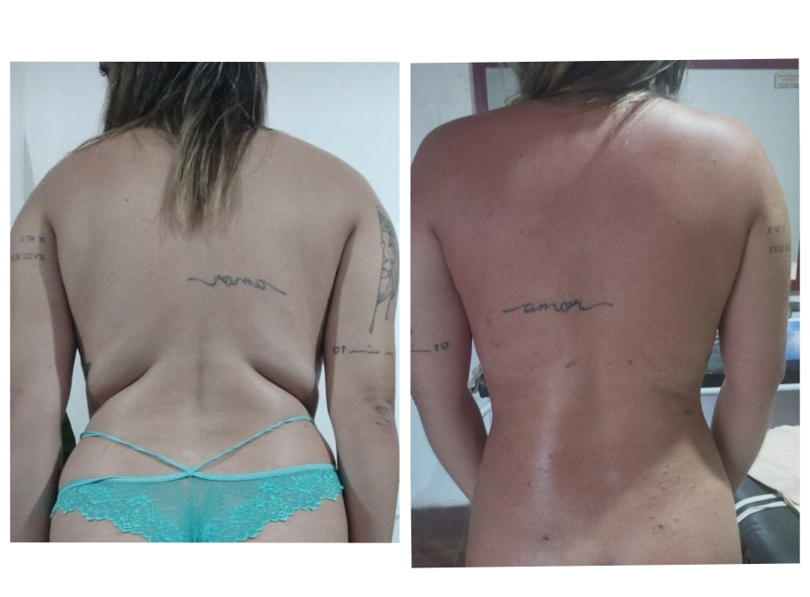 Antes e Depois Minilipolaser - Costas