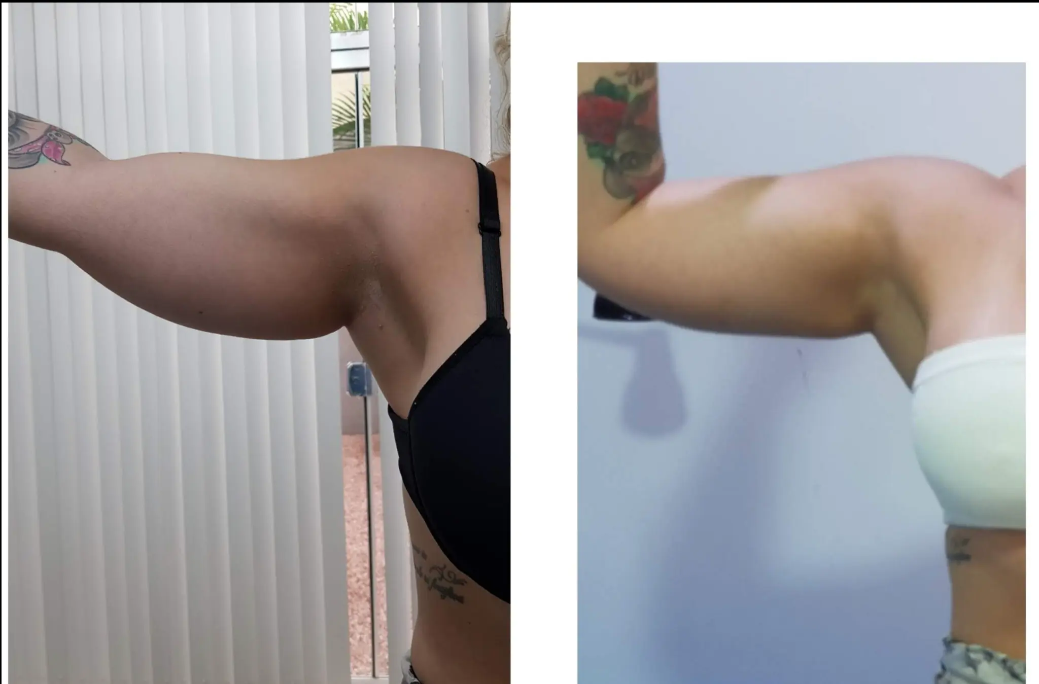 Antes e Depois Minilipolaser - Braços